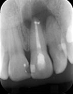 endodontic surgery for tooth with persistent infection