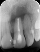 root tip of a tooth after apical surgery