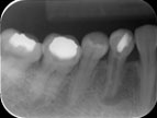 root canal immature tooth