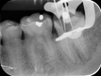 root canal treatment procedure