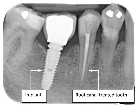 dental implant vs root canal